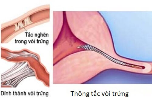 Phương pháp thông tắc vòi trứng